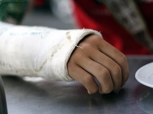 Хирурги РКБ сохранили мужчине отсеченную пилой руку
